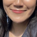 강남 팔자주름 시술 효과, 쥬브젠 자가진피재생술 내돈내산 후기