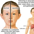 암환자의 황달(Jaundice) 증상 이미지