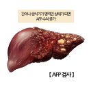 알파태아(胎兒)단백(AFP or αFP ; Alpha-fetoprotein)과 간암의 관계 이미지