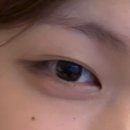 유태안「피곤한 사람 | 절개 쌍꺼풀 수술 후기 : 수술 당일-7개월