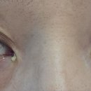 오줌으로 눈다래끼 치료 이미지