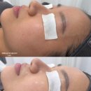 뉴세라 | 수유역 피부관리 요이에스테틱 뉴라라필 후기