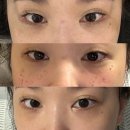 방화역 3번출구 | 방화역 &lt;Room110 스킨앤바디&gt; 강서구 색소 제거 만족 후기. before &amp; after.