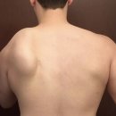 더올림단계평원초센터 | [동탄어깨] 팔 내릴 때 뚝뚝 소리와 불편감? 클라이밍 매니아의 익상견갑 교정기
