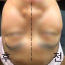 NR-3[성남대로]-상-719 | <서윤피부맑음 정자점> 초강력 작은얼굴 옆라인3센치가 뭘까요??? /분당피부관리/ 정자피부관리/ 정자동...