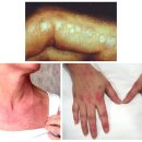 염증성 근육병 (Inflammatory Myopathies) 이미지