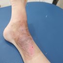 삼성서울도담외과의원 | 라면물에 2도 화상, 화상전문외과로 진료보기