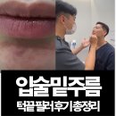 입술 밑 주름 생기는 원인? 턱 끝 필러 마리오네트 주름 정리