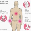 한국인의 골감소증 골다공증 이미지