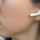 하대동264 | [진주 피부관리 추천] 하대동 피부관리 "유엔뷰티" / 진주 여드름 압출 후기 😮