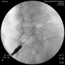 암성 통증 환자의 신경차단술(Nerve Block)이란? 이미지