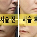신논현역피부과 콜라겐부스터 레디어스 콜라겐주사 받고온 후기