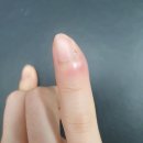 마스터즈정형외과의원 | 조갑주위염(생인손) 치료 2주간의 기록 후기! (수술X)