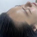 (주)코리아세븐 서초논현점 | [헤어라인교정] 강남 smp 헤어라인두피문신 블랙카운티 3회 후기 ₍ᐢ. ̫.ᐢ₎♡