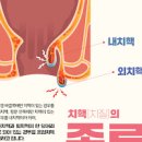 항문 통증을 유발하는 주요 질환 항문거근증후군 치핵 치루 포함 이미지