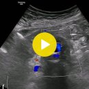 AA Graft caused by abdominal aorta aneurysm 이미지