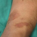 상지초등학교 | 상암피부과 색소침착 치료 후기｜직접 받아본 손목 화상 흉터 레이저토닝