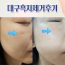대구흑자제거 대구동성로피부과에서 리팟레이저받고 달라진 변화과정 후기
