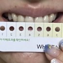 화이트7 | 페리오 화이트 나우 치아 미백 패치 7일 후기 사진 주의!