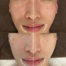 회원동168 | [마산 작은 얼굴디자인관리]피부,피어나리에서 얼굴 리프팅과 불균형 개선까지 모두 극뽁~(남자얼굴 편)