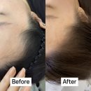 호수헤어라인 | 시흥 은계 두피채우기: 뷰티수연 헤어라인 후기 신세계를 맛보다