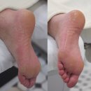 덕천빌딩 | 부산 발톱무좀 레푸스 덕천점 발 각질 제거 관리 후기