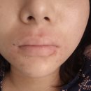 바름한의원 | [신도림] 신도림 생기한의원 후기 입술아토피/아토피 피부 루틴 피부템