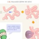 장꼬임 증상 치료 장폐색 해결 방법 이미지