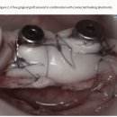 미소심는치과의원 | 영통구 치과 추천 , 연조직 이식술 (CTG)은 무엇일까요