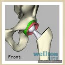 대퇴골두무혈성괴사=고관절인공관절수술(THR) 이미지