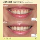 스마일라인치과의원 | 잇몸성형 거미스마일 교정 총정리 (방법, 후기, 부작용)