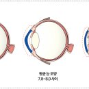 드림콘택트렌즈 이미지