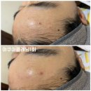 라렌느헤어 | [공지] 강남 스킨플래닝 아쿠아필과 만났다 라렌느 강남점 아쿠아플래닝