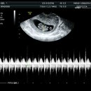 차메디컬산부인과 | [임신 8주차] 임산부 병원비 할인, 미래아이 산부인과, 3번째 산부인과 정착