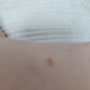 아이가루 | 아이 사마귀 치료 율무가루 후기(진짜 없어짐)