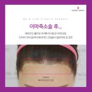 자연앤동물병원 미용실 | 이마축소 흉터교정 모발이식 1년 후 │ 모앤라인 헤어라인 후기