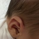 로드성형외과의원 | [육아] 신생아 스킨텍 수술 지디에스성형외과 예약 및 후기