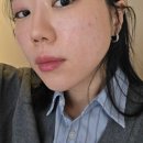 여우야문구 | 압구정 쥬브아셀 8% 풀페이스 시술 후기, 2주 후 사진 비교