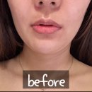 프롬채 | 수원 에스테틱 '프롬채' 소멸관리 후기