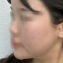 스페셜성형외과의원 | 안양울쎄라, 볼패임 부작용 없이주름 탄력효과 제대로 보는 방법? (꿀팁,가격, 예약)