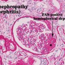 신 증후군(Nephrotic Syndrome)에 대한 임상 이미지