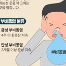 급성 만성 부비동염 축농증 원인 증상 치료 약 이미지