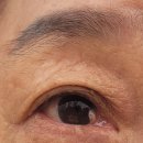 이안과의원 | [병원] 눈에 살이 생겼다면? 군날개 제거 수원 이안과의원 수술 후기 👀