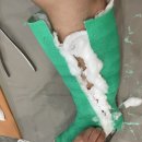 방그레병원 | 중족골 기저부 골절 5주차 통깁스 풀고 다시 반깁스 비수술후기