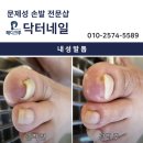 내성발톱 병원 안가고 문제성 손발 전문샵에서 관리해야하는 이유 #청주내성발톱 #청주발톱무좀 이미지