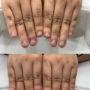 시흥 아크릴연장 시그네일 시흥 물어뜯는손톱교정 성공! 리얼 감동후기