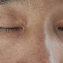 xanthelasma) 제거 성형수술 후기, 하안검 지방제거수술, 흉터제거수술, 논현역 인근 에이블리 성형외과