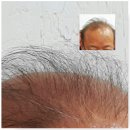 대망의 탈모치유! 모낭 줄기세포에 작용하는 혁신적 국소용 탈모치료제 헤어짐(Hairzym) 이미지