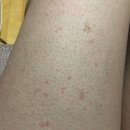 도토들아 이거 땀띠일까?? (사진주의...혐) 이미지