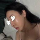 명동역피부과 비올 실펌X 기미치료 내돈내산 후기(당일~1주일 경과)